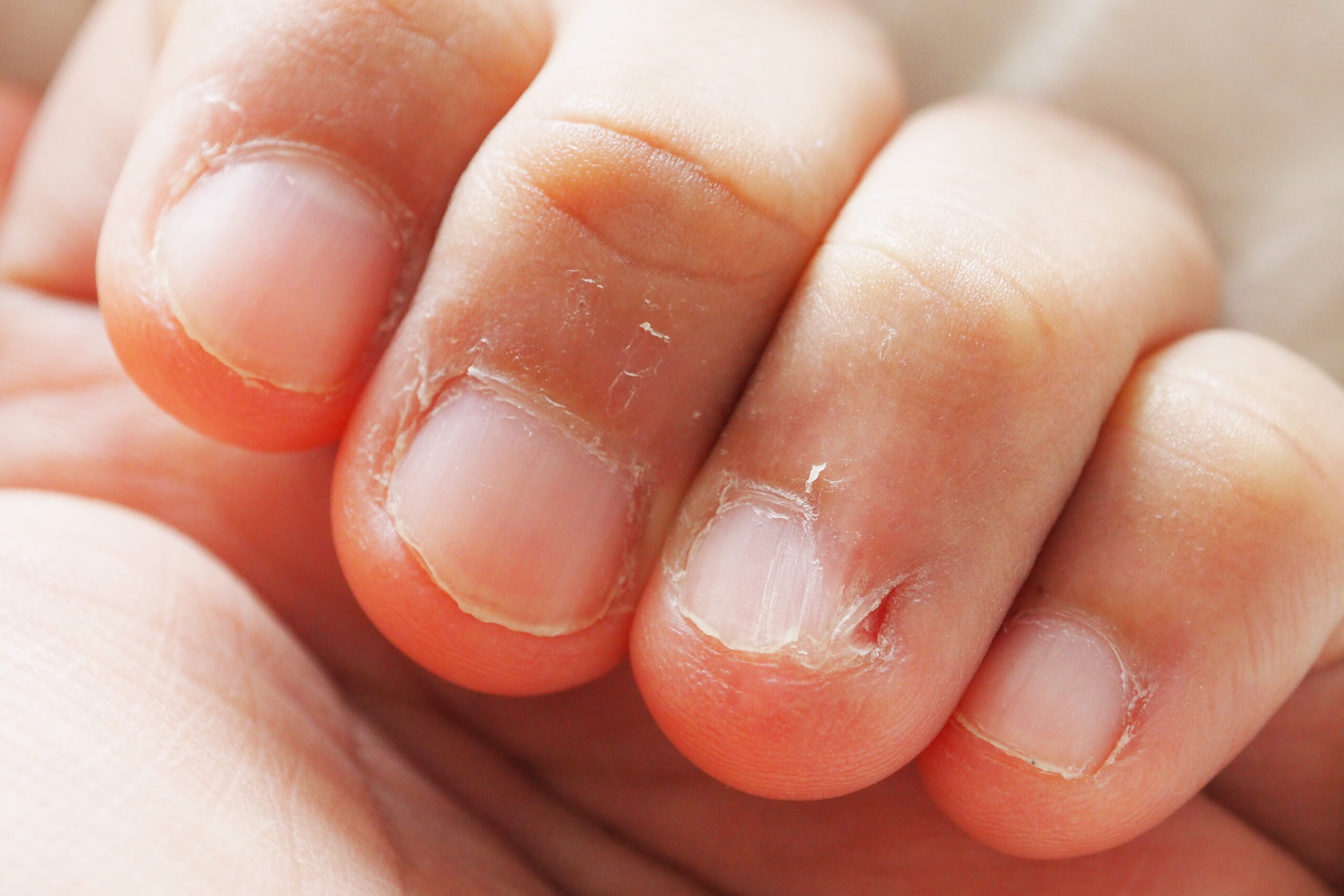 have tried acrylic nails but with my bpd I just changed to biting. has  anyone tried those thumb gloves? : r/calmhands